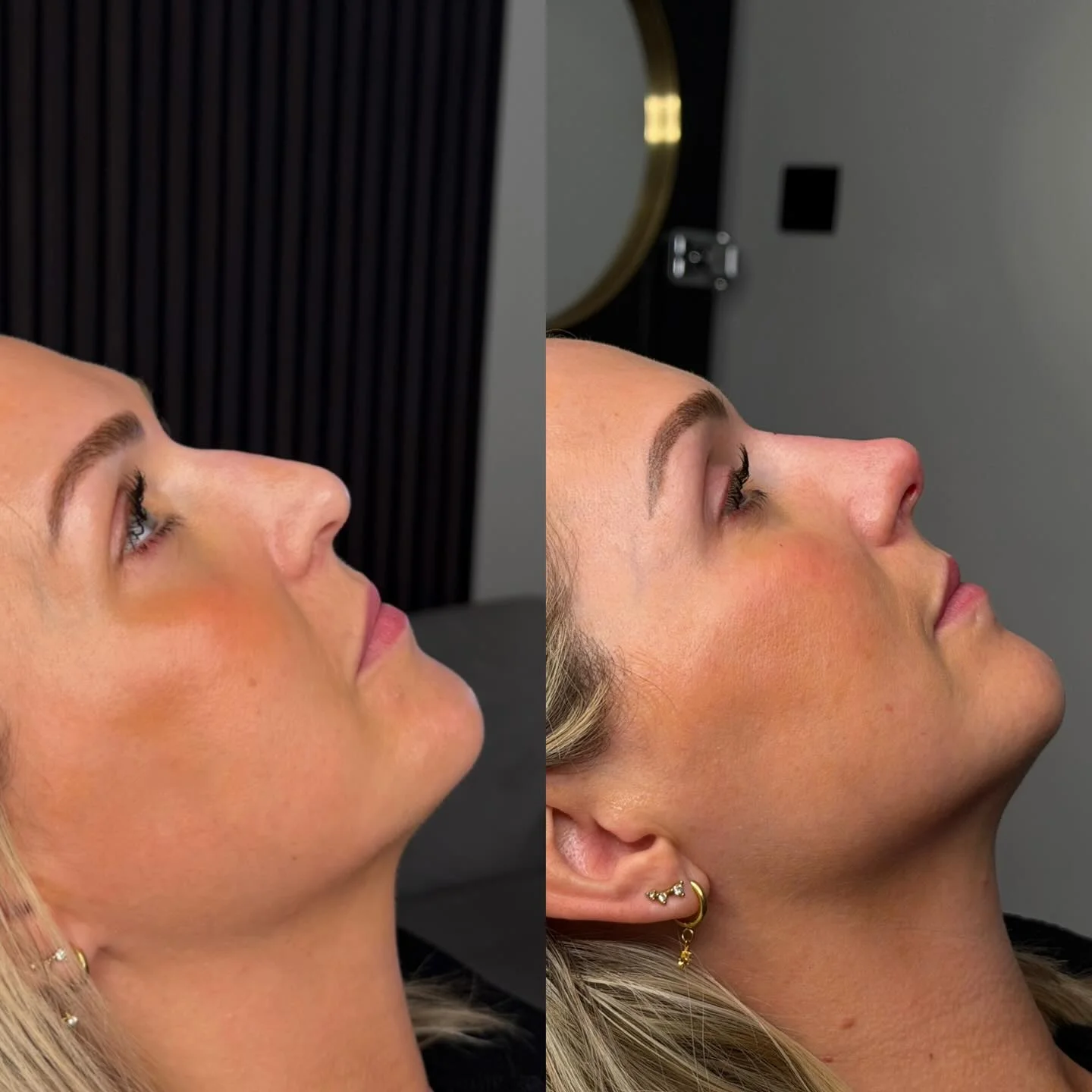 Real Non-Surgical Rhinoplasty Result 12 at Burns Salon Luton
