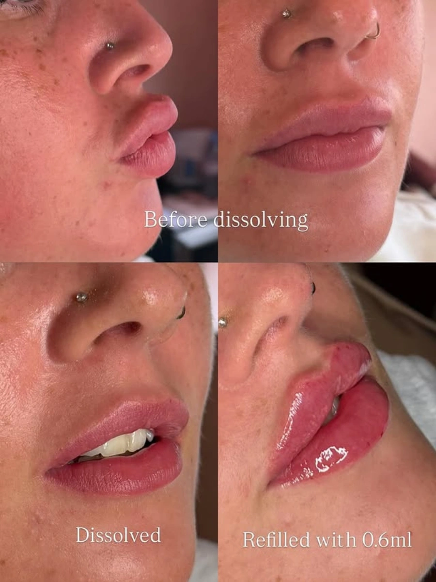 Dissolve & 0.6ml Refill - Migration removal to fresh definition