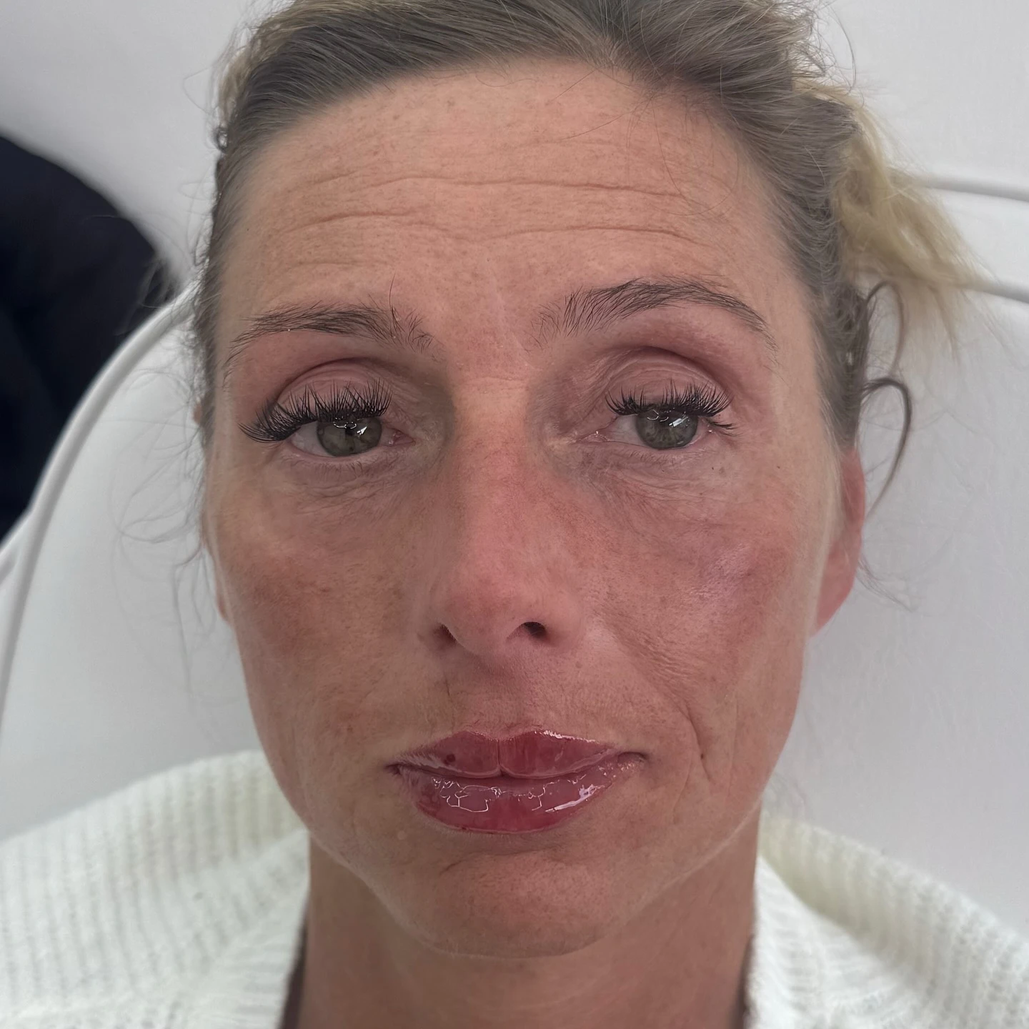 Tear trough filler under-eye hollow smoothing before and after transformation at Burns Salon Luton - After