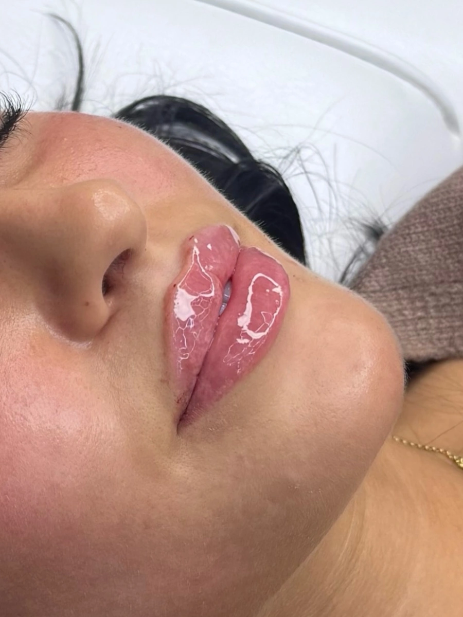 Real Lip Filler Result 7 at Burns Salon Luton