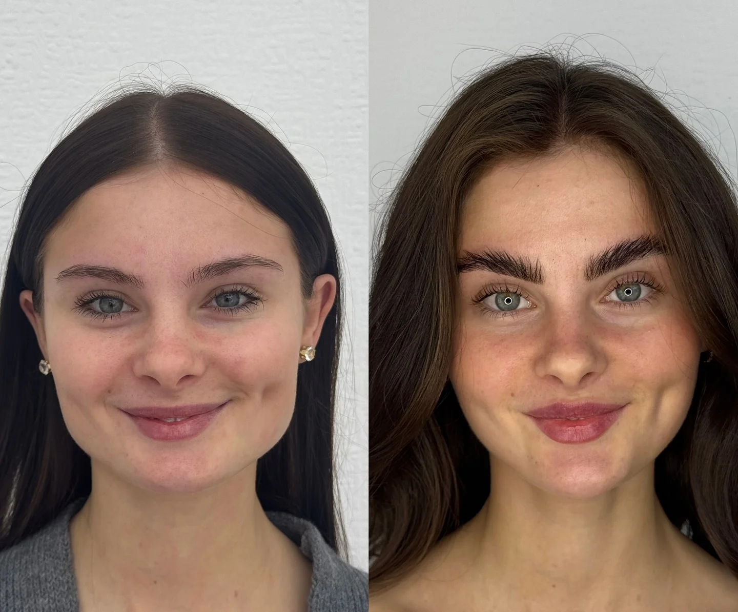 Dermal Fillers & Contouring at Burns Salon