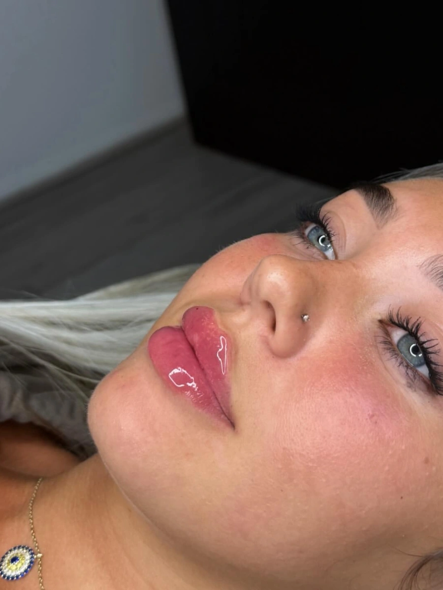 Real Lip Filler Result 9 at Burns Salon Luton
