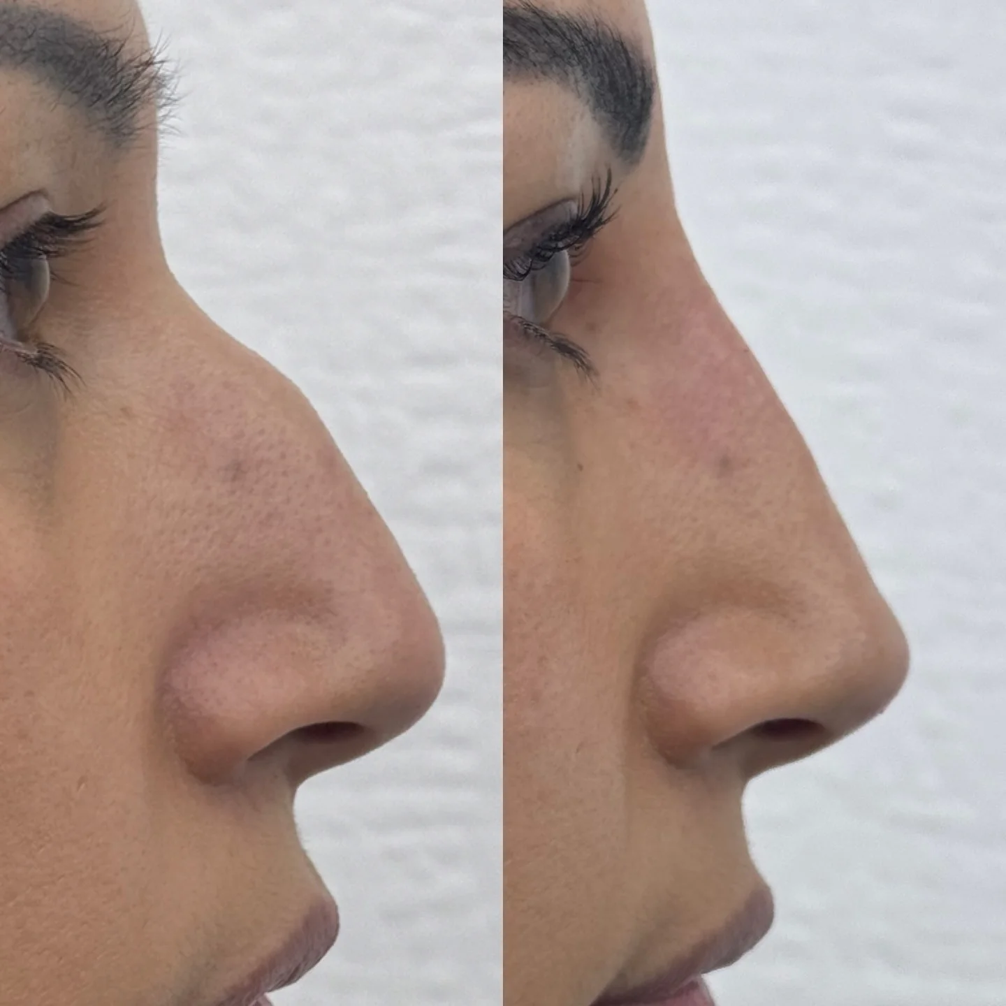 Non-Surgical Rhinoplasty at Burns Salon