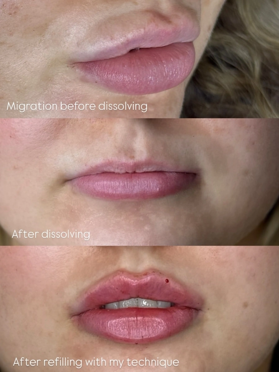 Migration Reset & Refill - Border migration reset to balanced lips