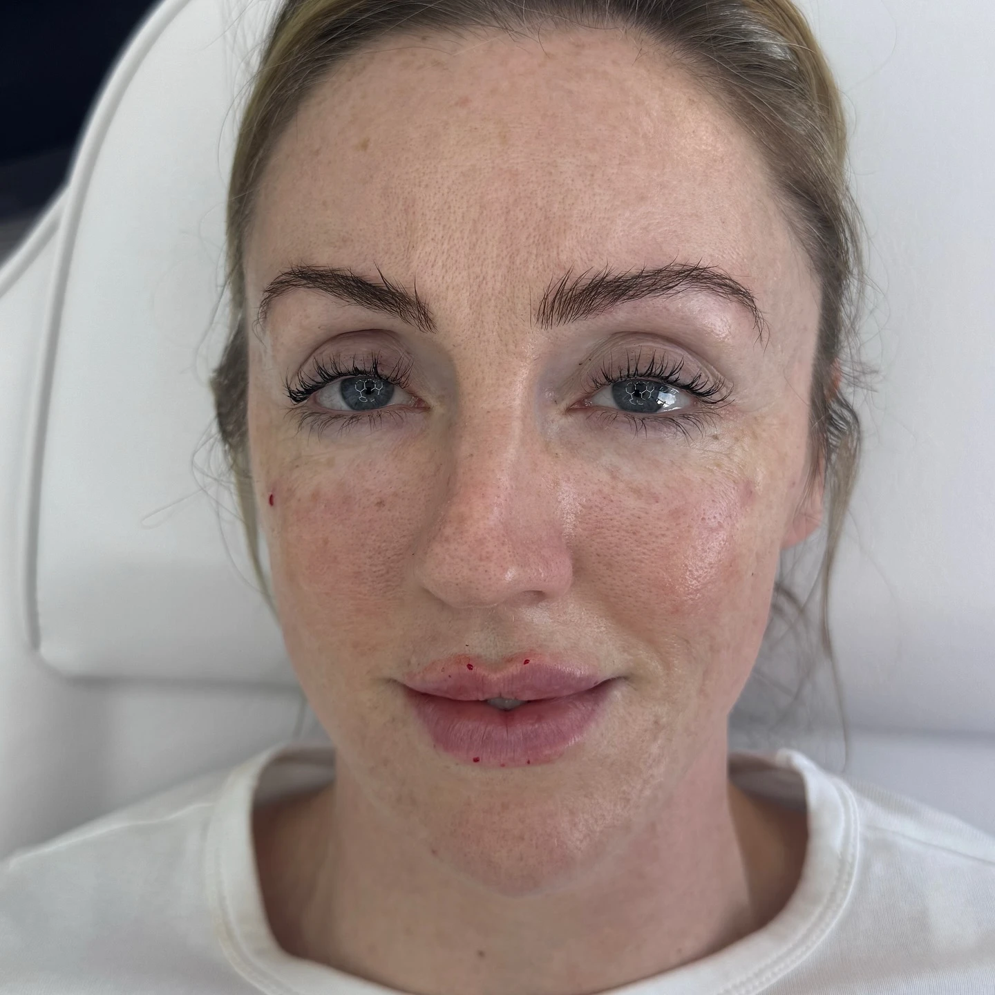 Tear trough treatment dark circle and under-eye smoothing before and after transformation at Burns Salon Luton - After