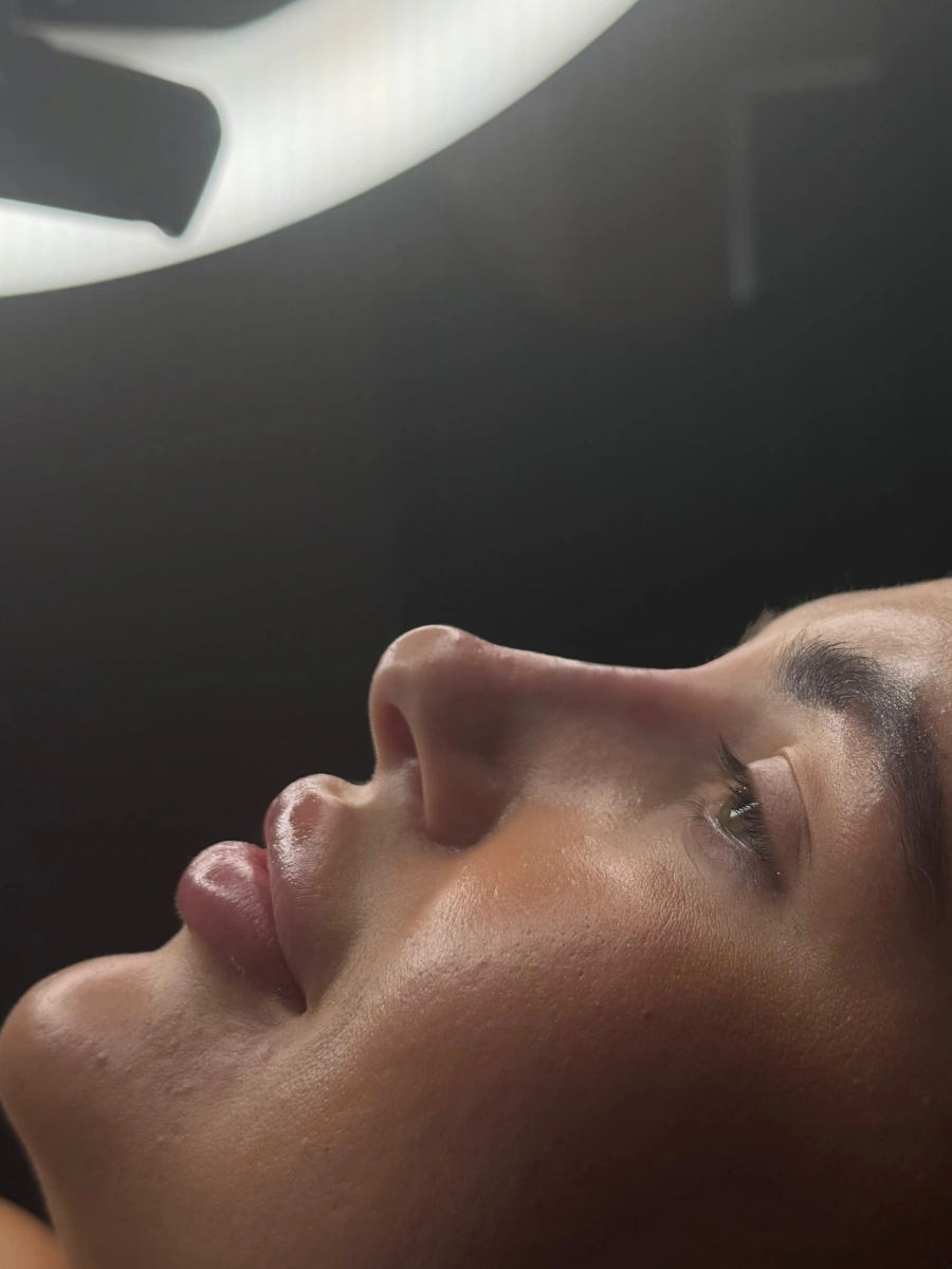 Real Lip Filler Result 4 at Burns Salon Luton