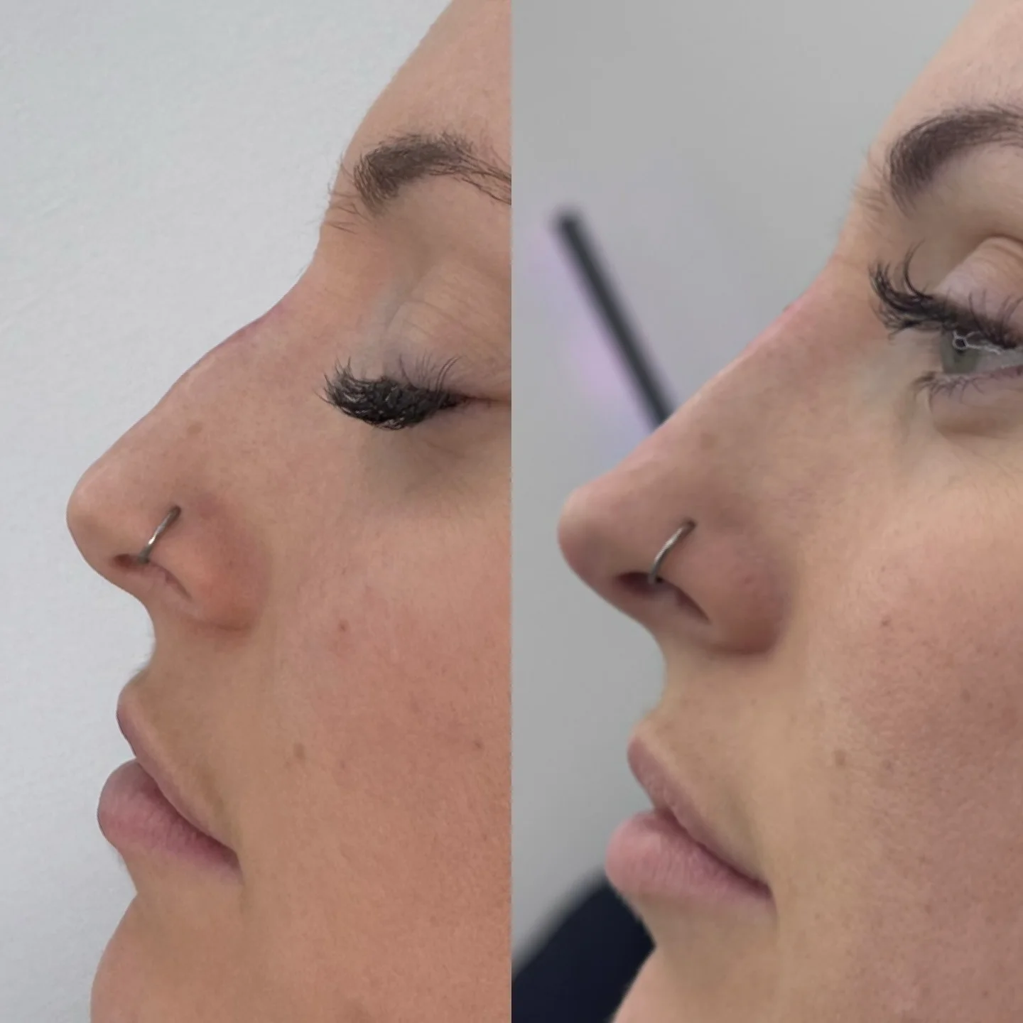Real Non-Surgical Rhinoplasty Result 2 at Burns Salon Luton