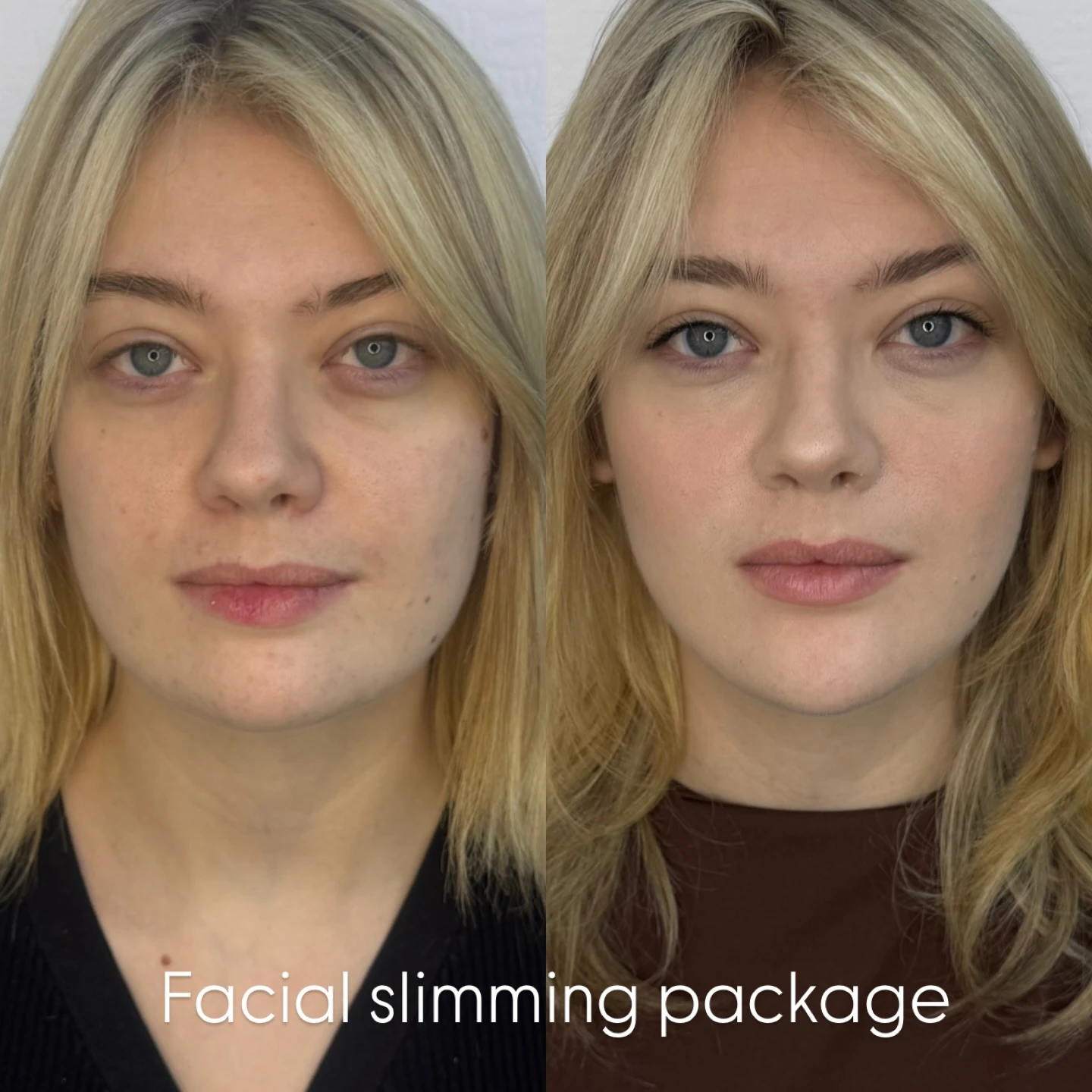 Facial slimming masseter anti-wrinkle injections softening a square jawline at Burns Salon Luton