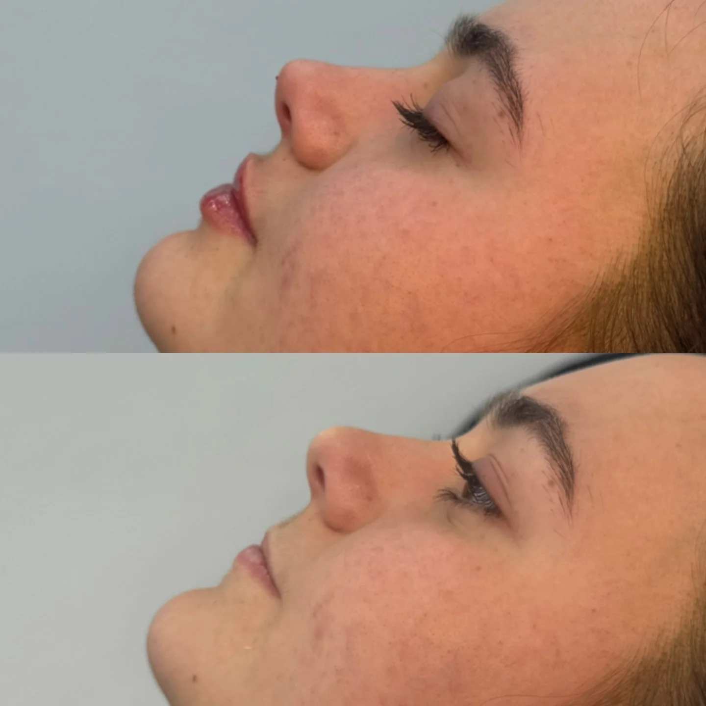 Real Non-Surgical Rhinoplasty Result 10 at Burns Salon Luton