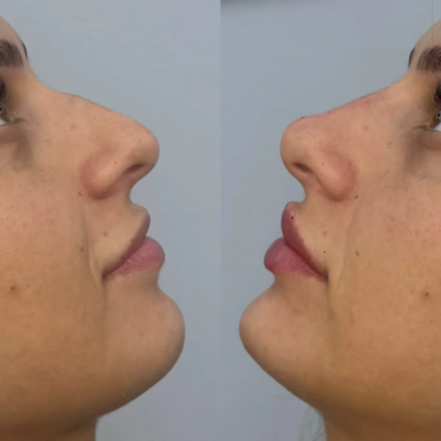 Real Non-Surgical Rhinoplasty Result 8 at Burns Salon Luton