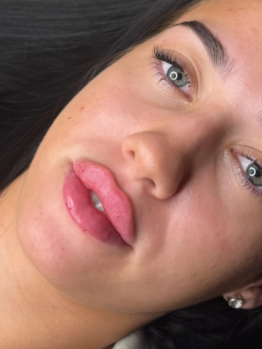 Lip Fillers at Burns Salon