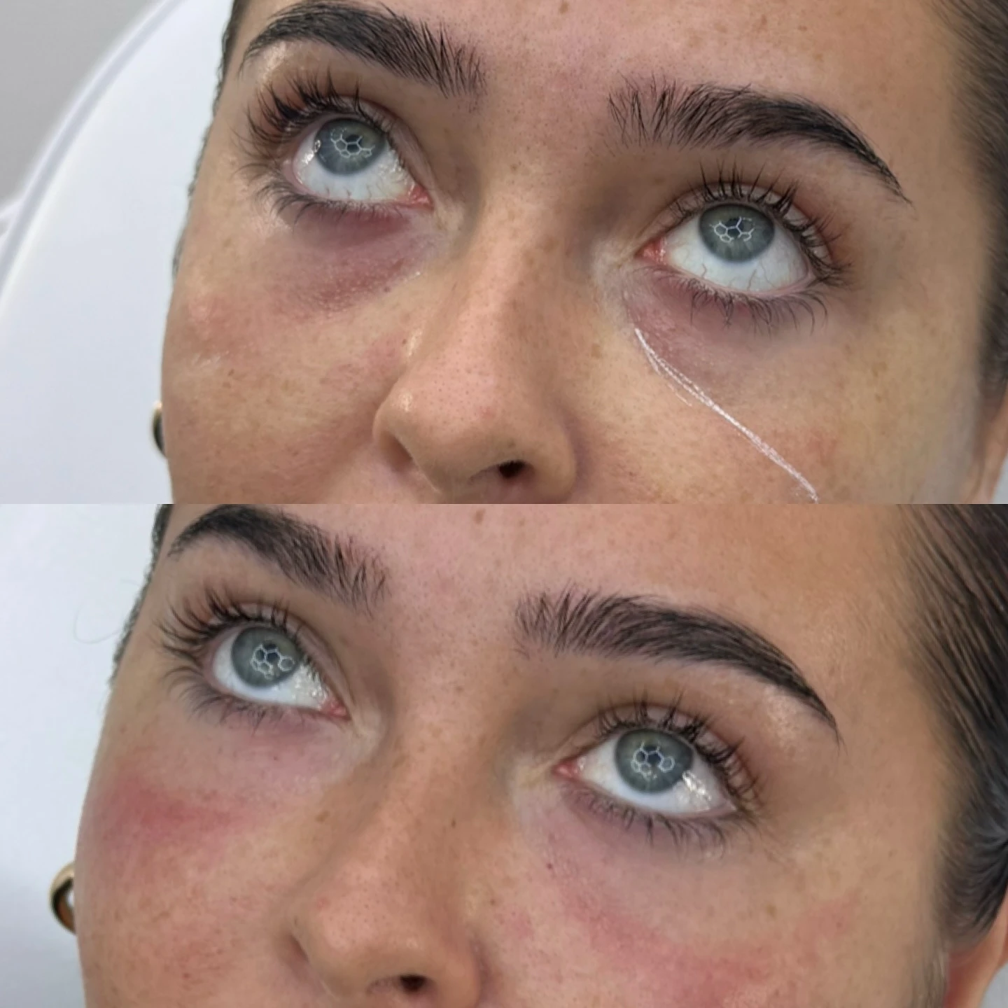 Tear trough under-eye filler transformation before and after at Burns Salon Luton