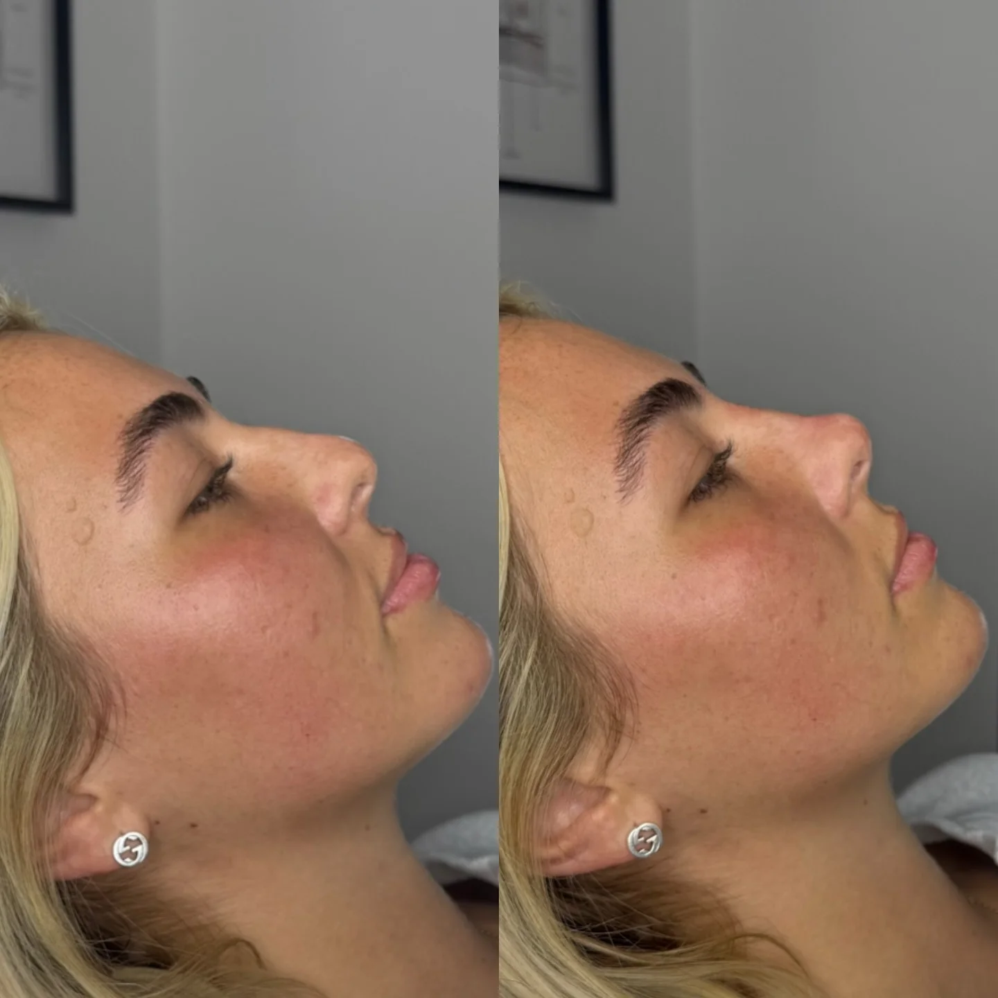 Real Non-Surgical Rhinoplasty Result 16 at Burns Salon Luton