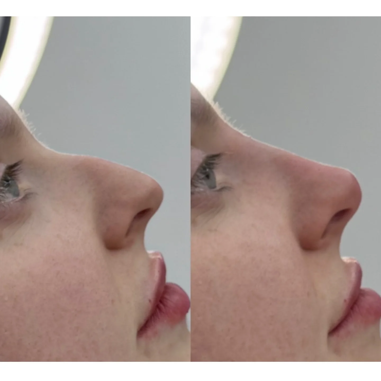 Real Non-Surgical Rhinoplasty Result 15 at Burns Salon Luton