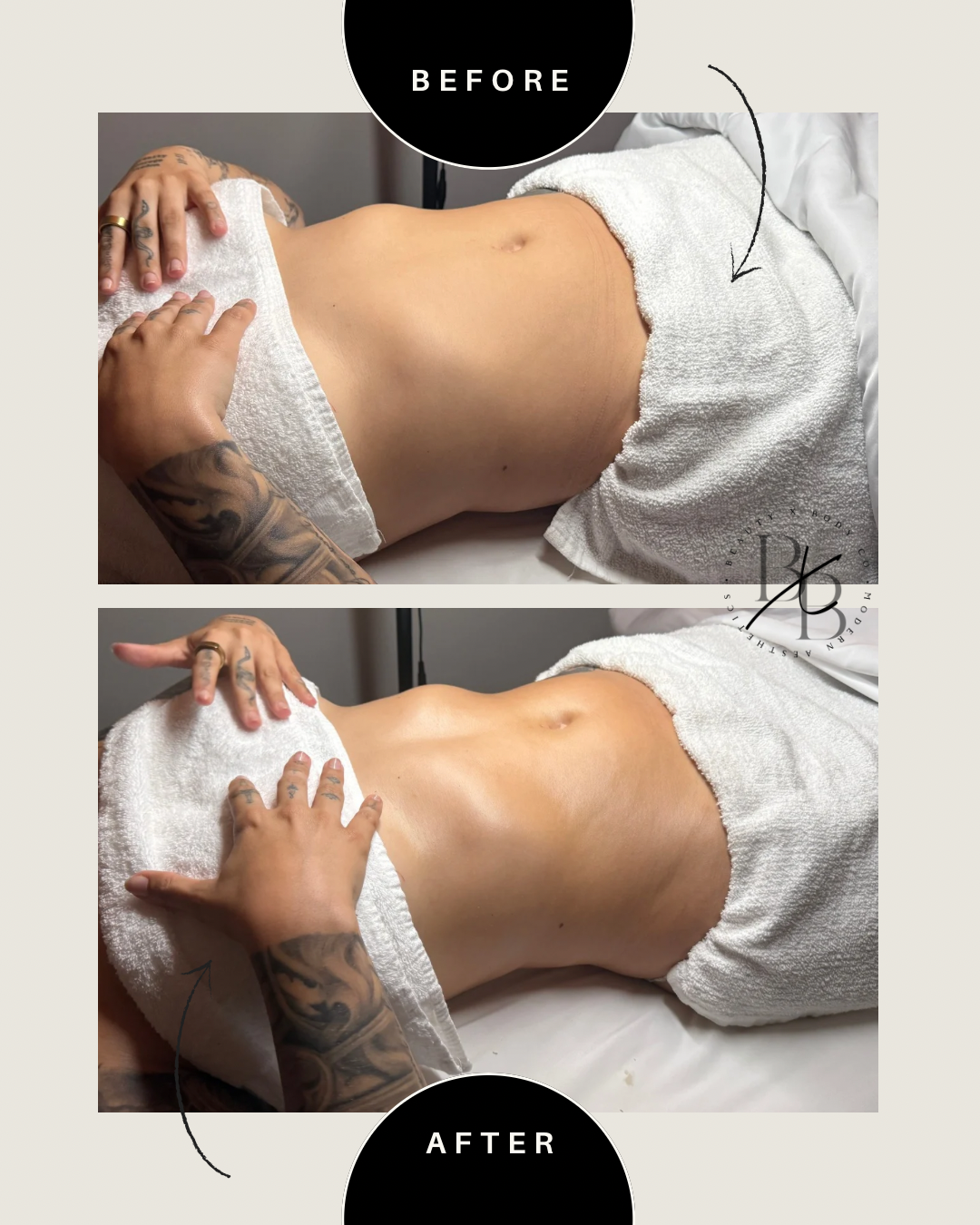 Client result showing visible abdominal sculpting
