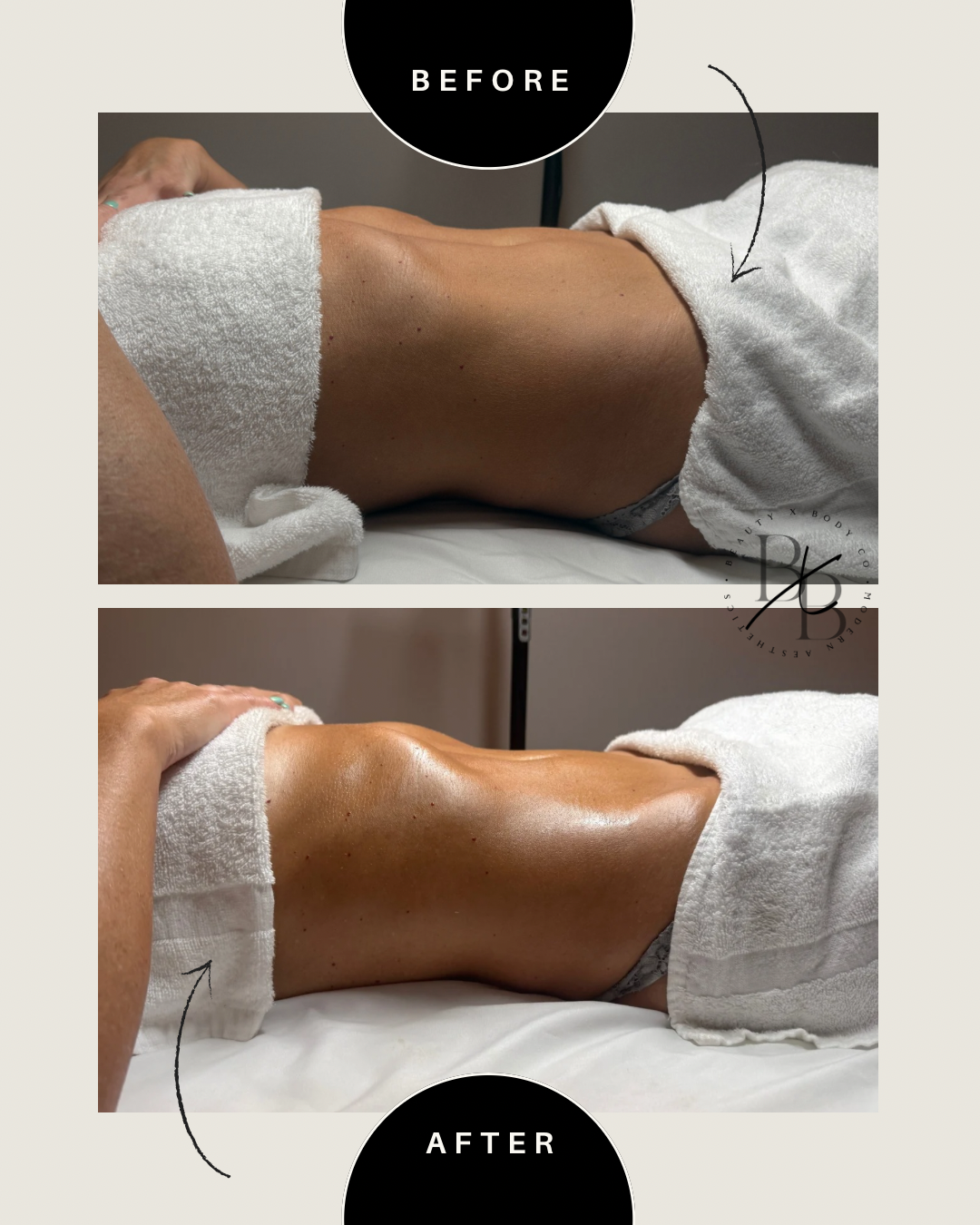Client result showing waist contour and reduced bloating
