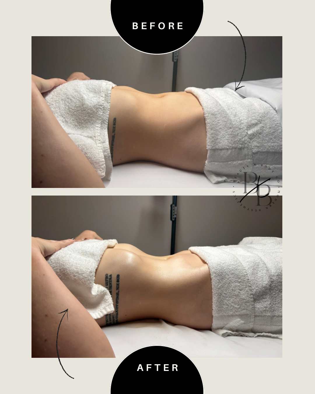 Client result showing toned side profile contouring