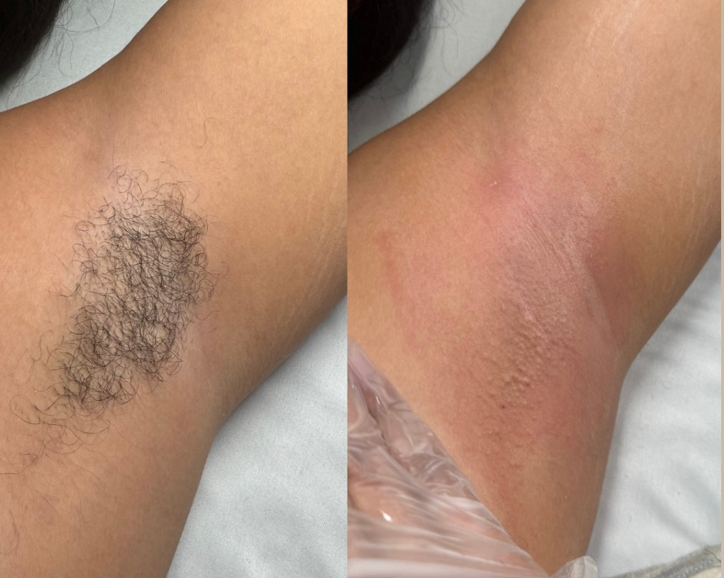 Underarm Waxing Transformation