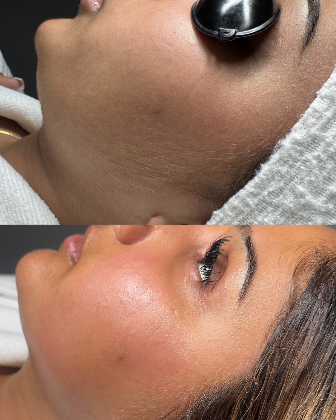 Facial Treatment Results