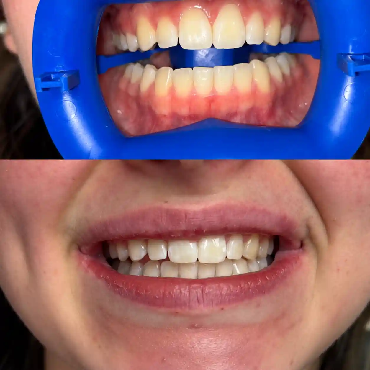 Fogfehérítés előtti és utána fogszín összehasonlítása az Avenue Dental Budapestnél