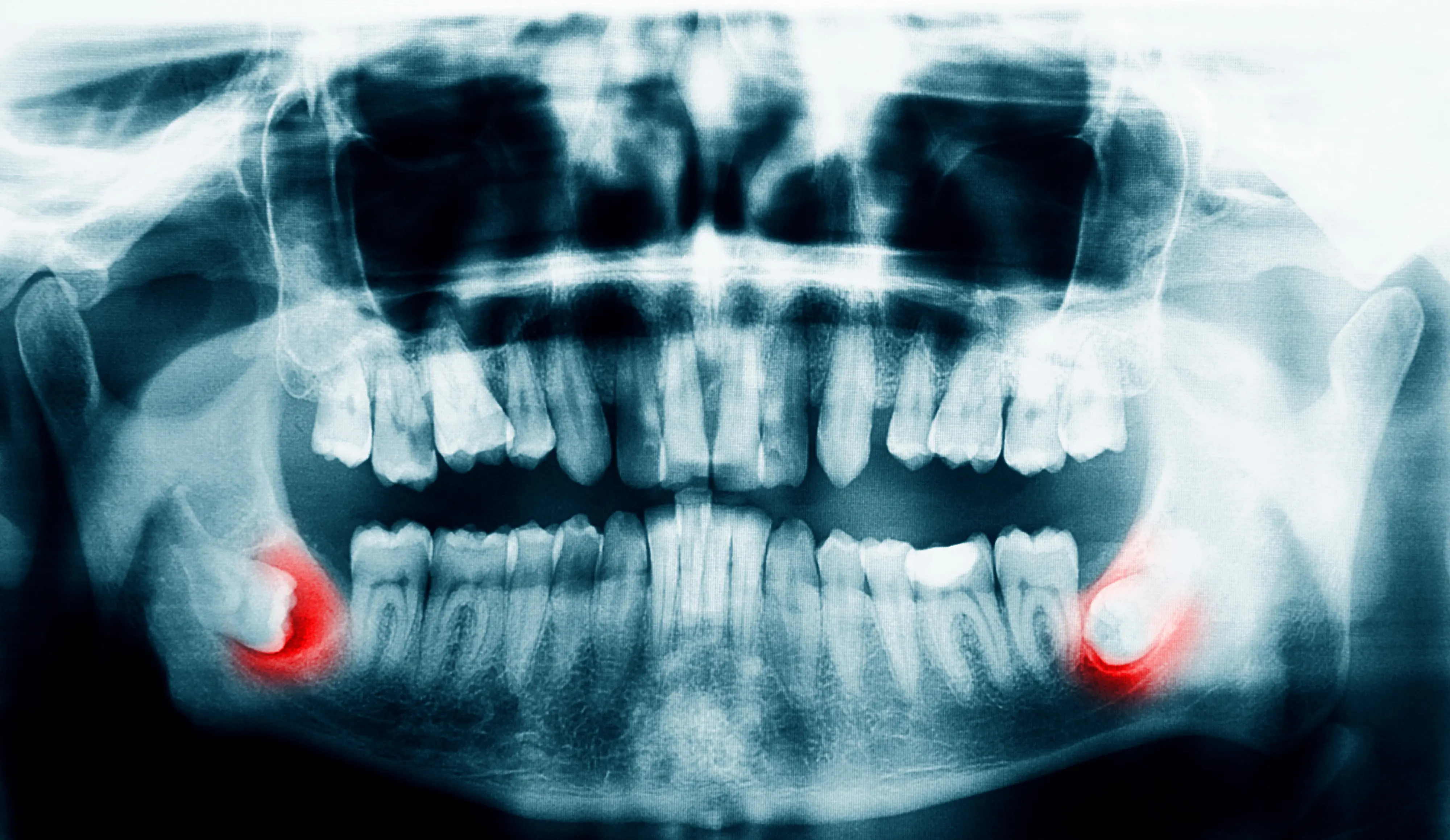 Panoramic dental X-ray showing impacted wisdom teeth for oral surgery planning