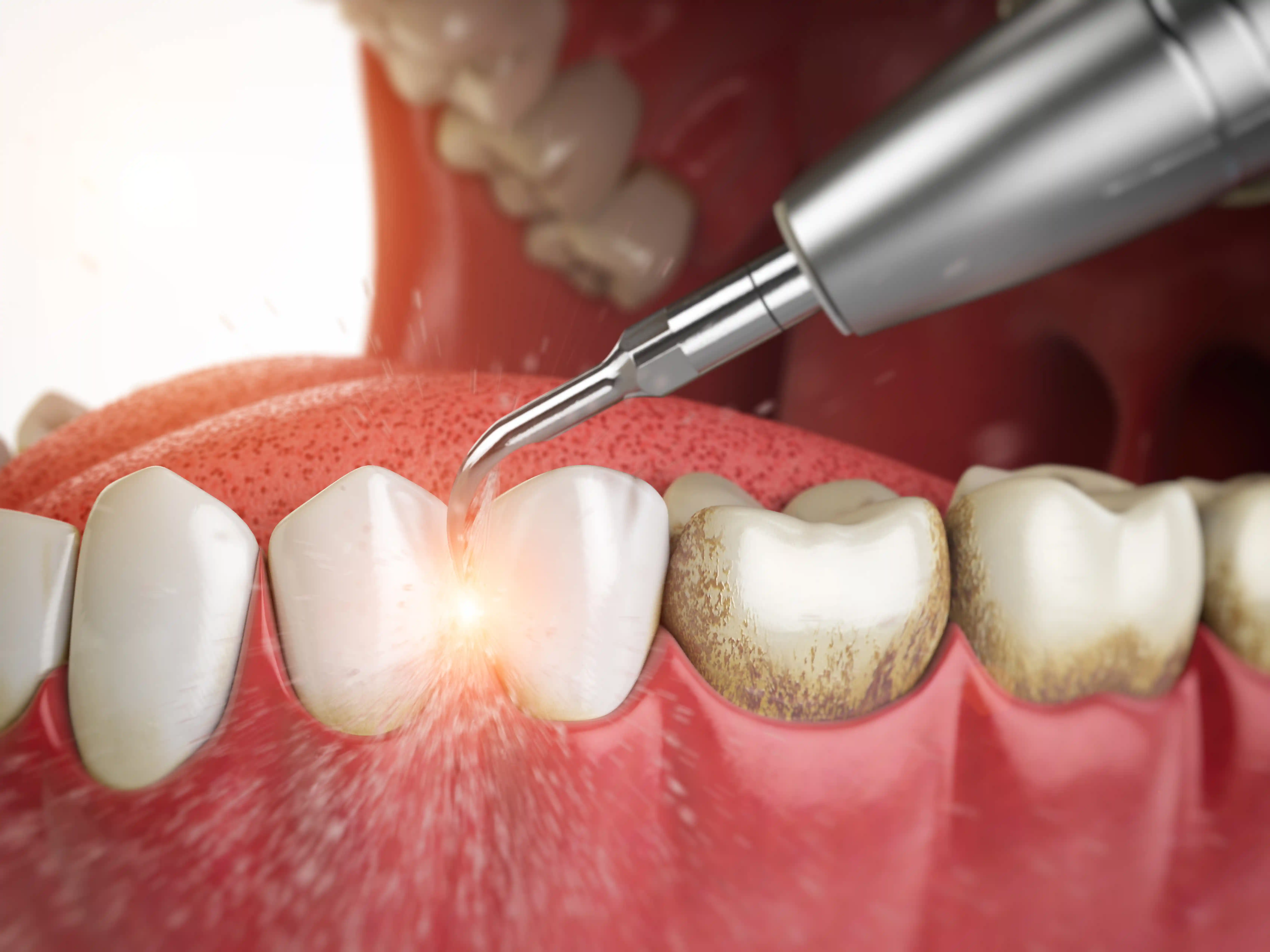 Illustration anatomique du détartrage ultrasonique et des dépôts sous-gingivaux
