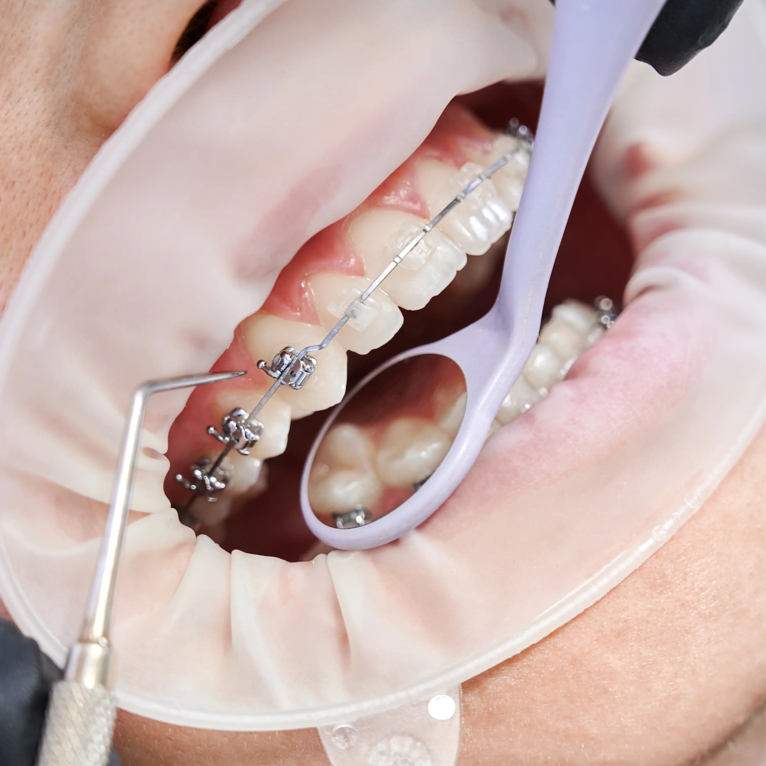 Fogszabályozási konzultáció és digitális készüléktervezés az Avenue Dental Budapestnél