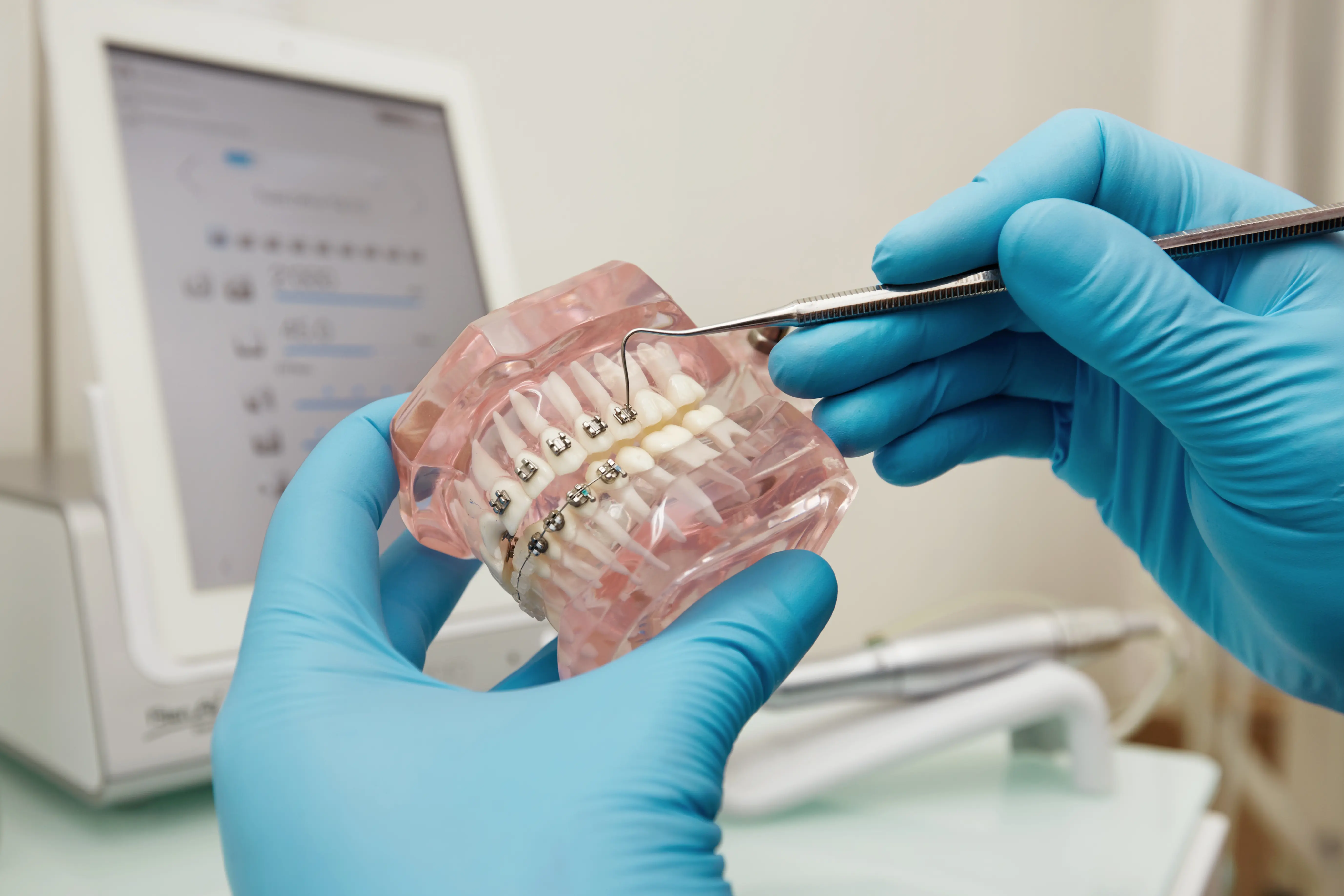 Klinikai fogszabályozó kezelés és precíz ívigazítás az Avenue Dental Budapest rendelőben