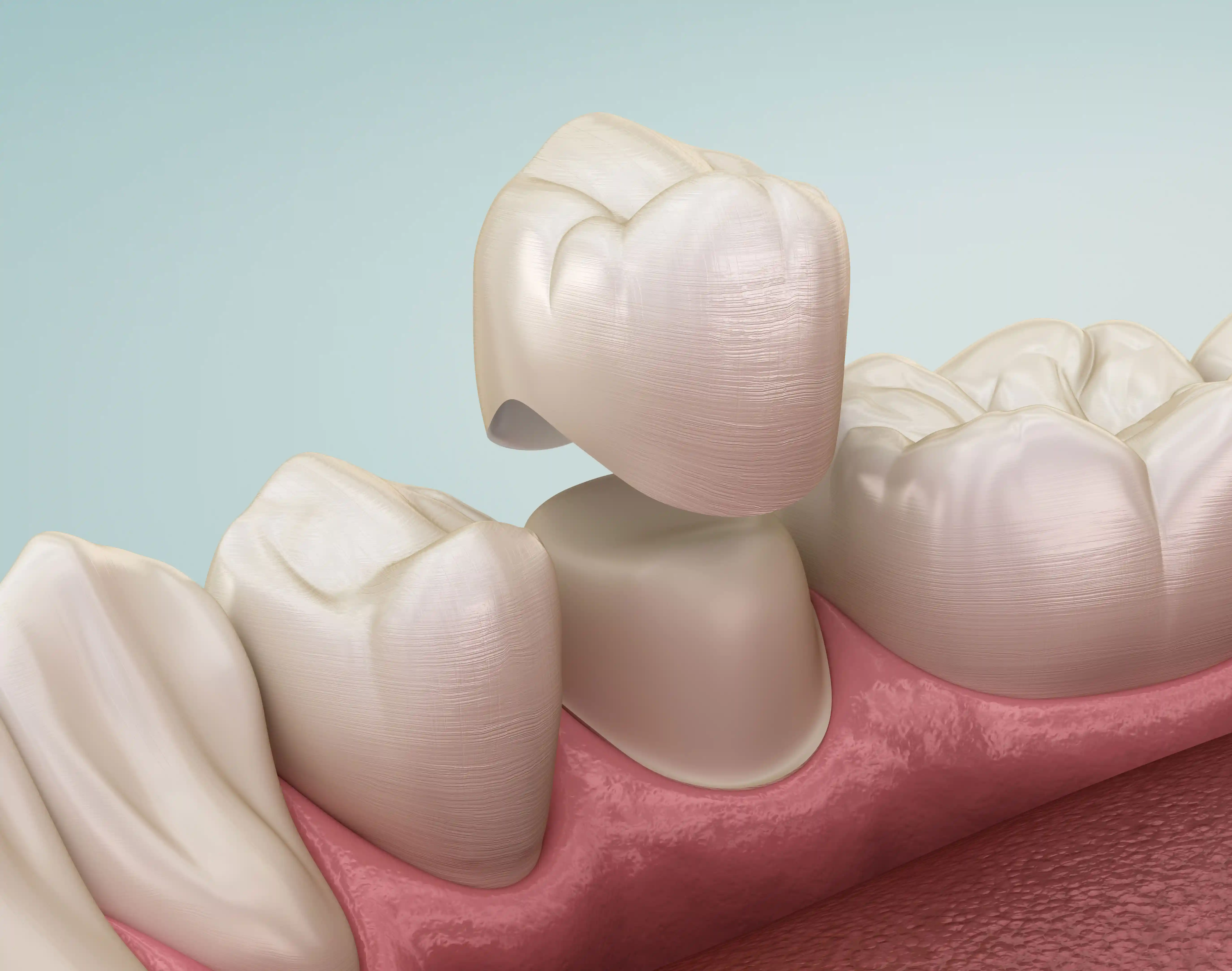 Fogászati korona precíz illeszkedésének és anatómiájának 3D szemléltetése a preparált csonk felett