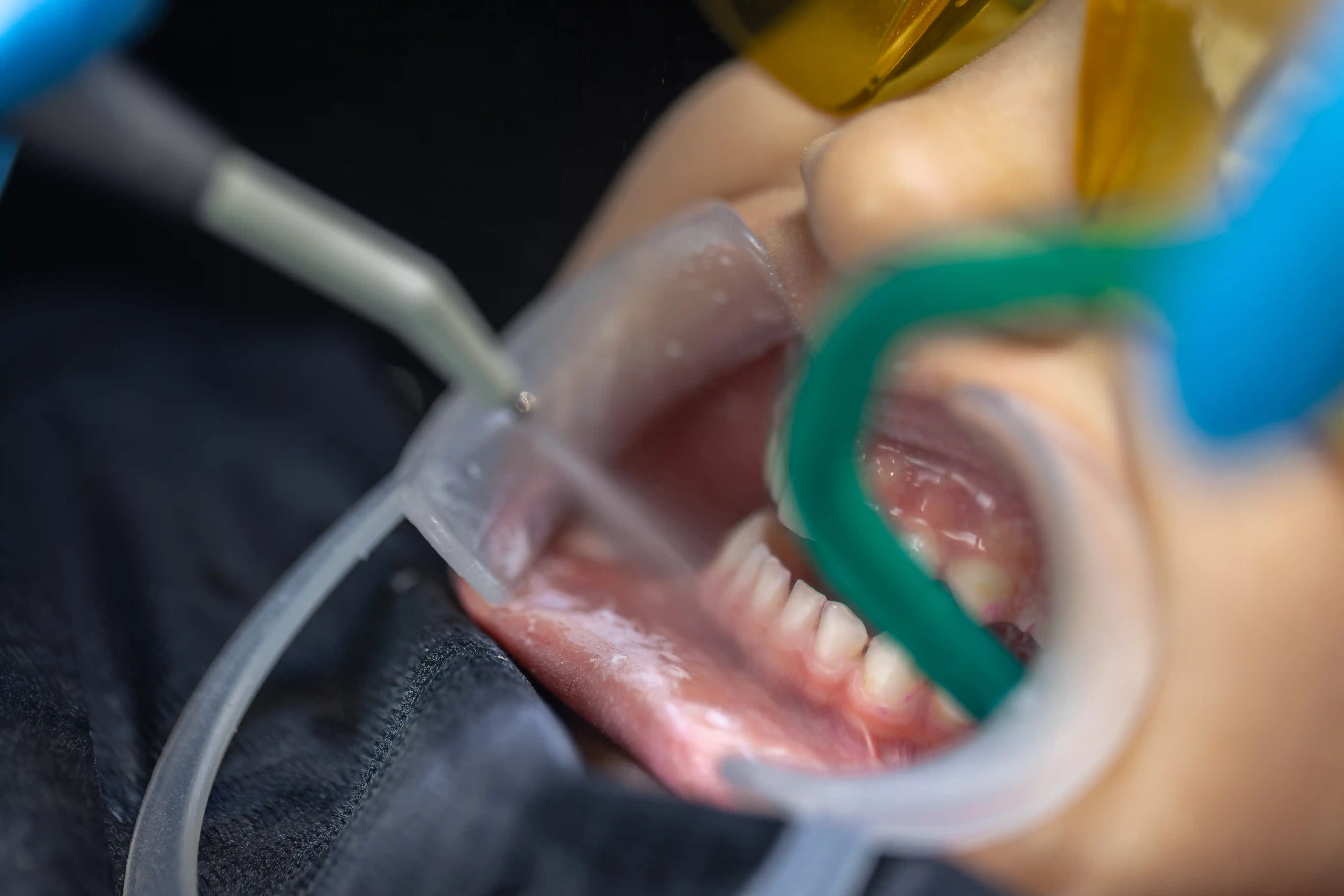 Procédure de nettoyage précise réalisée par un professionnel dentaire au cabinet Avenue Dental