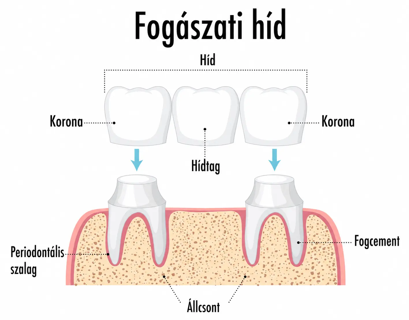 Fogászati híd és koronák anatómiai és technikai magyarázó ábrája az Avenue Dental oldalán