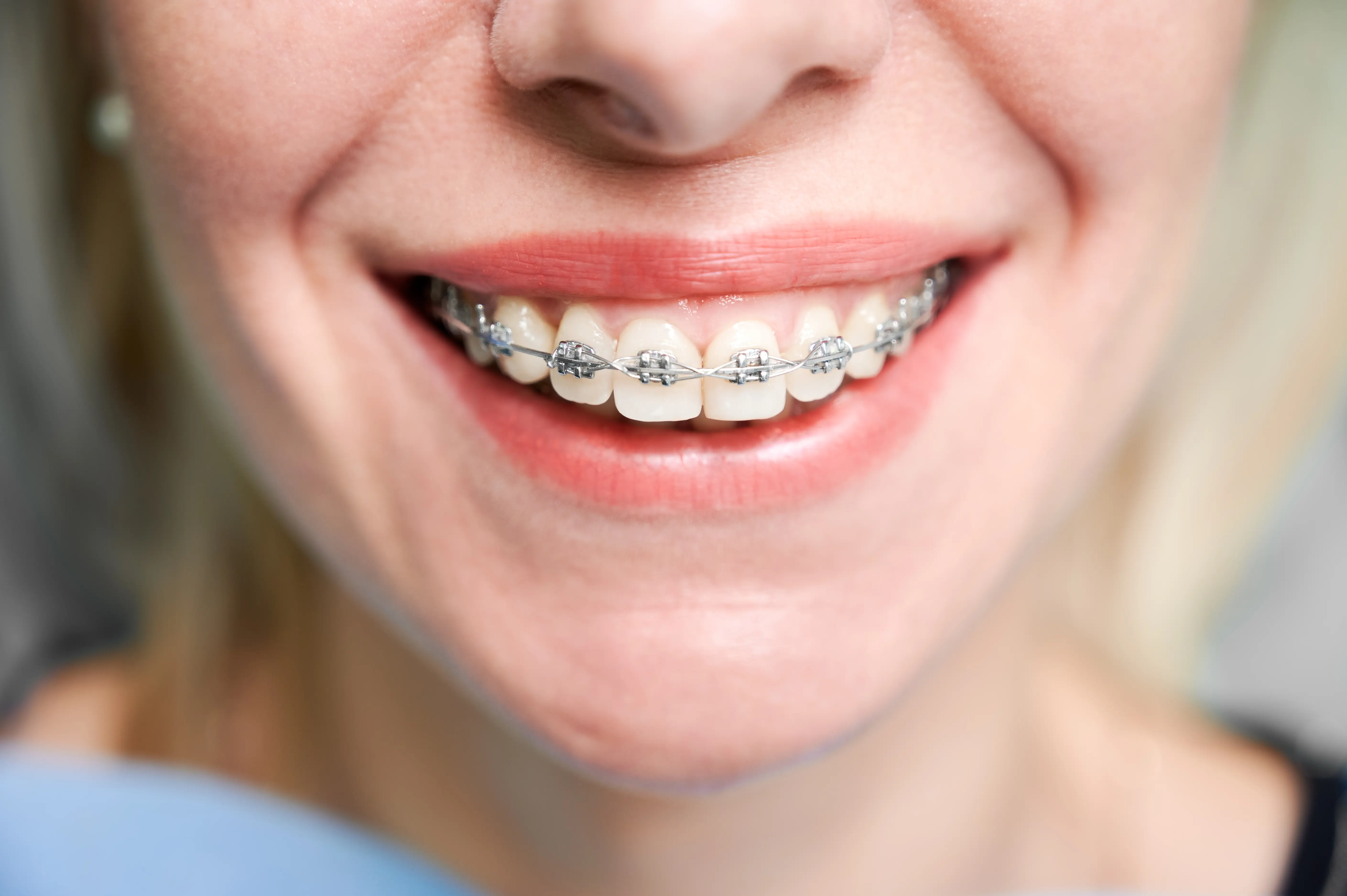 Esztétikus fogszabályozás és magabiztos mosoly az Avenue Dental Budapest rendelőben