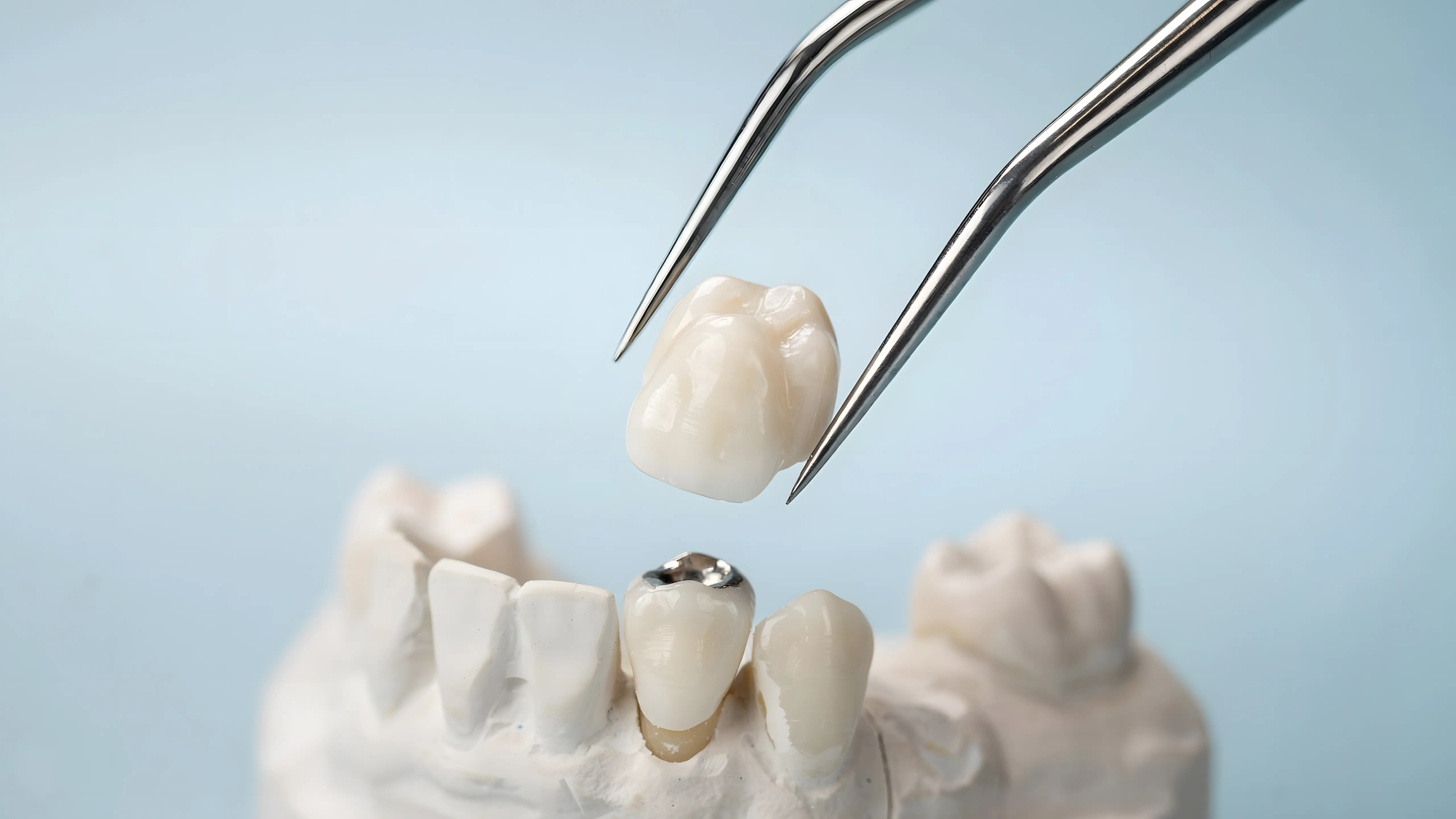 Precíziós fogászati korona illesztése és ellenőrzése gipszmodellen az Avenue Dental fogtechnikai folyamatában