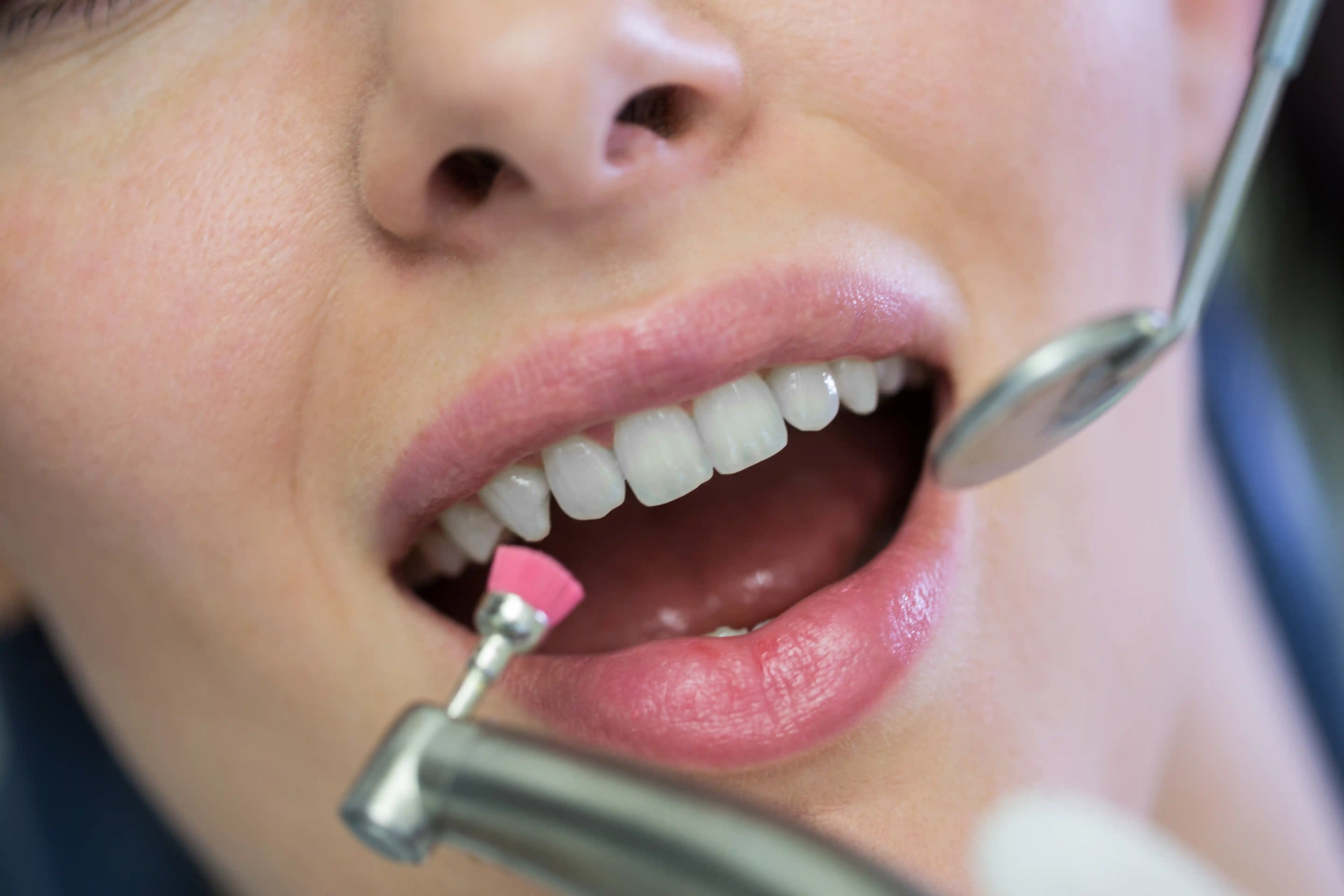 Professzionális dentálhigiéniai kezelés és ultrahangos tisztítás