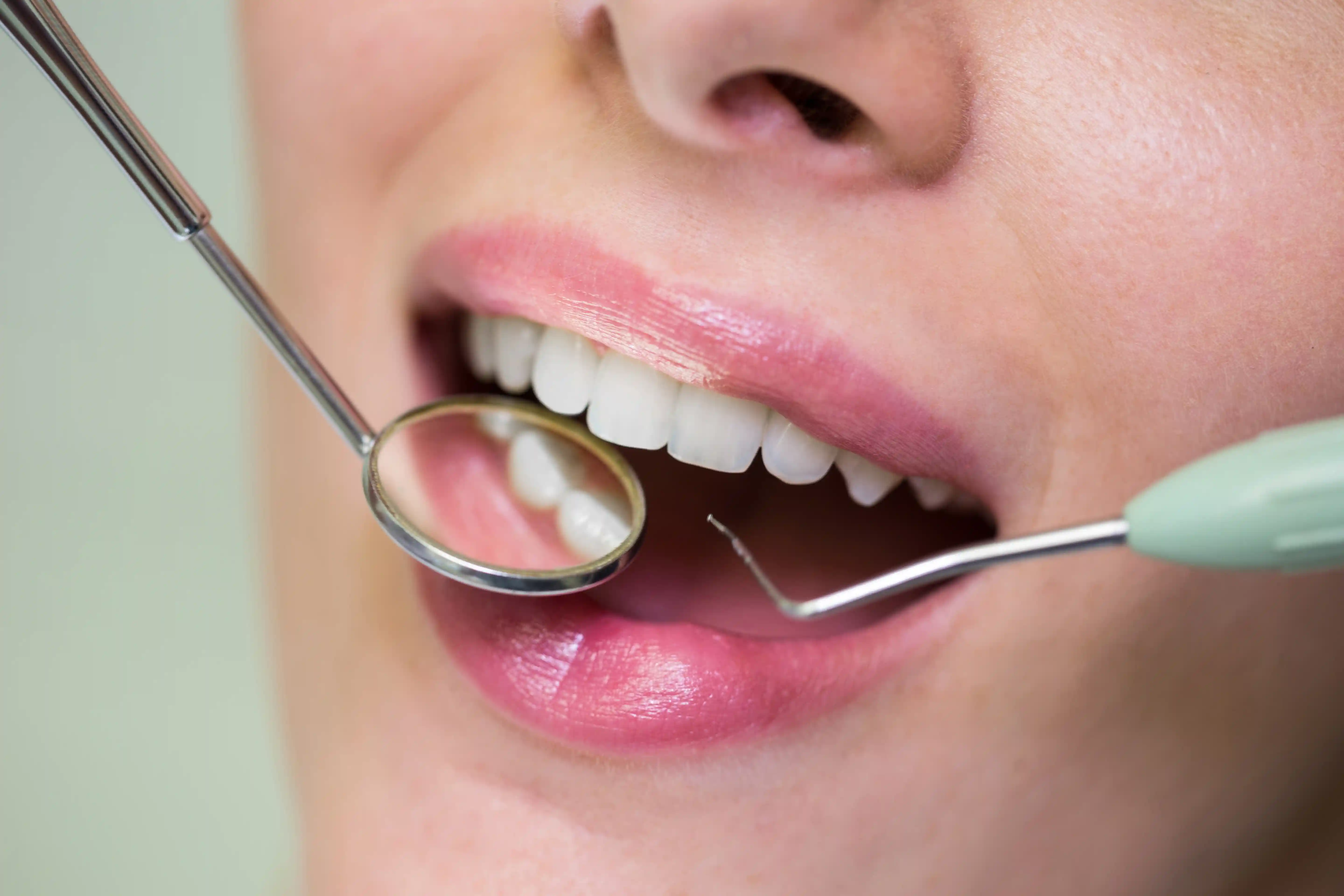 Aesthetic dental filling and natural-looking tooth restoration at Avenue Dental Budapest