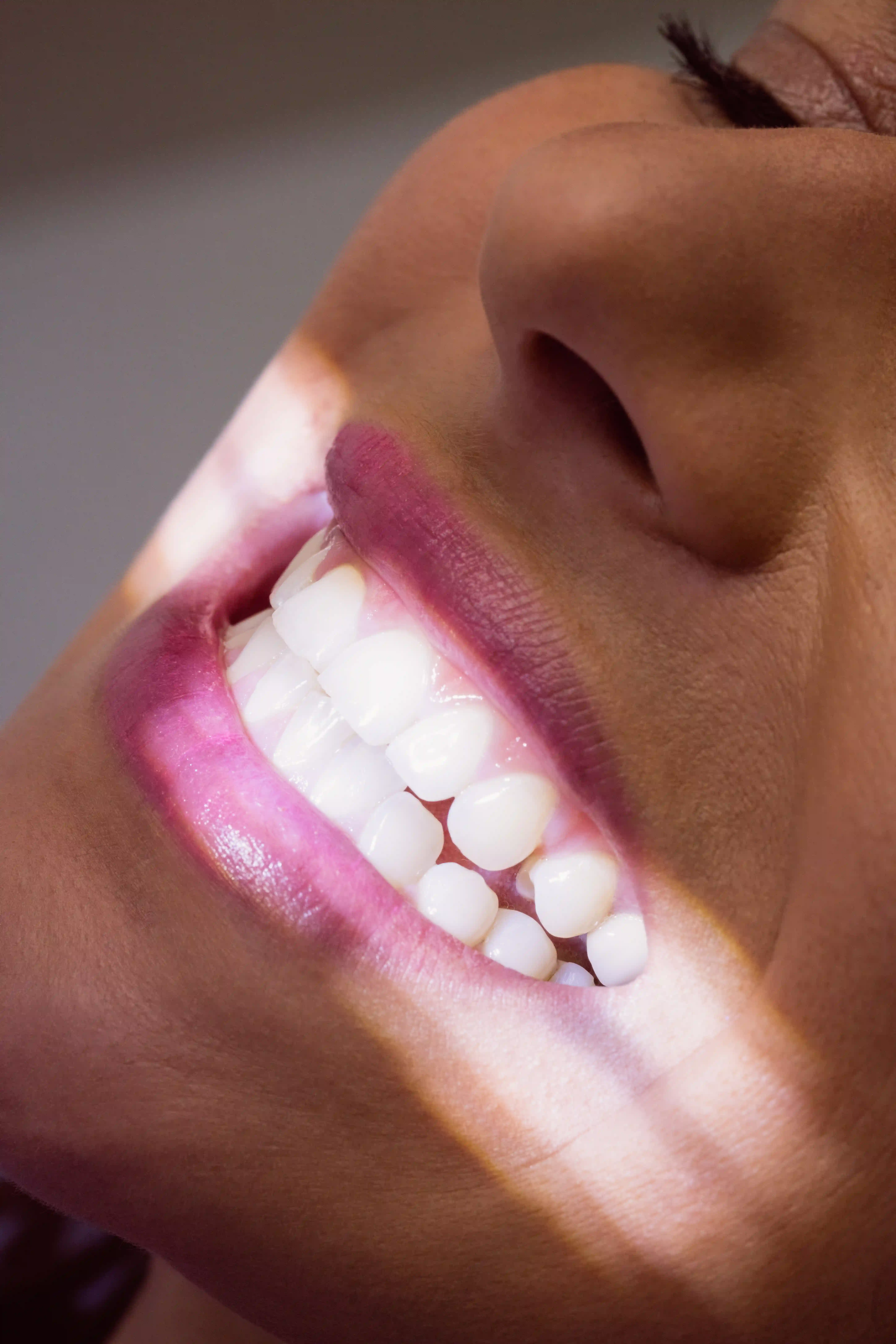 Professzionális fogfehérítés és természetes, világosabb mosoly az Avenue Dental Budapestnél