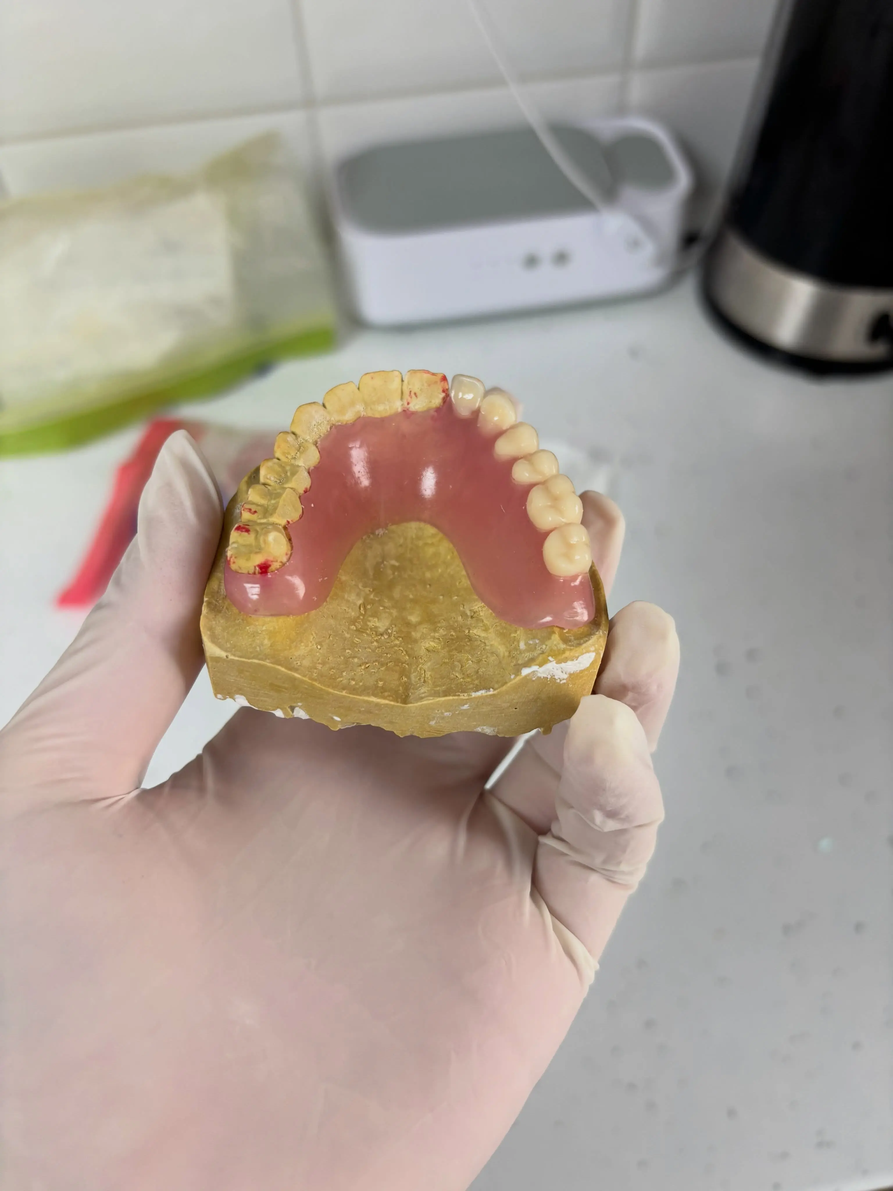 Paire de prothèses amovibles complètes supérieure et inférieure à conception anatomique précise au cabinet Avenue Dental