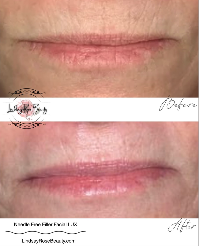 Real client before & after — skin texture & tone renewal
