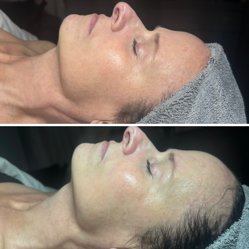 Real client before & after — facial collagen renewal