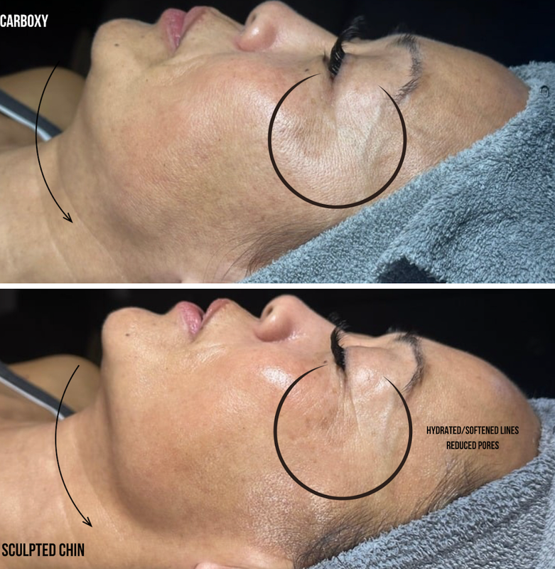 Real client before & after — forehead wrinkle softening