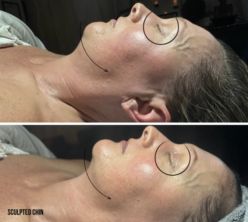 Real client before & after — needle-free filler facial results