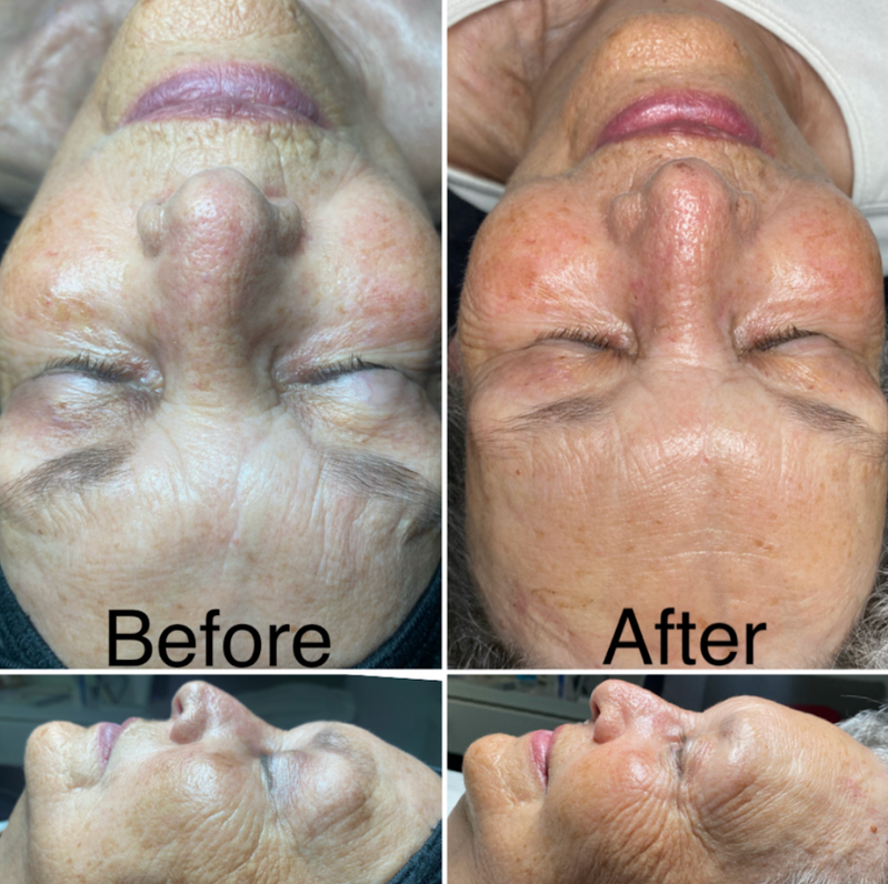 Real client before & after — full-face lifting transformation