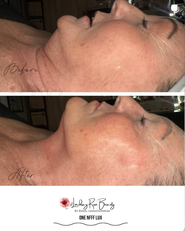 Real client before & after — brightening & even tone results
