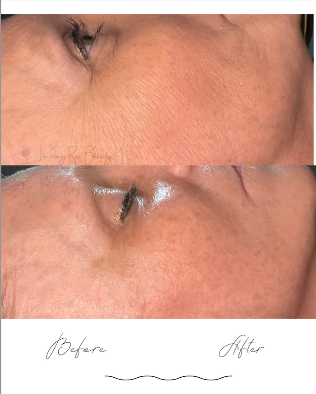 Real client before & after — jawline & facial contour definition