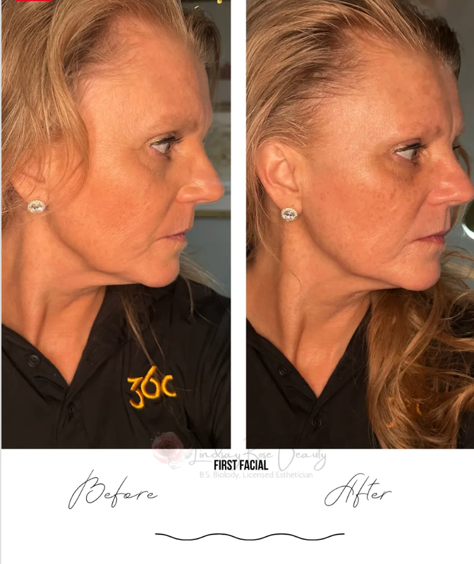 Real client before & after — skin lifting & firming results