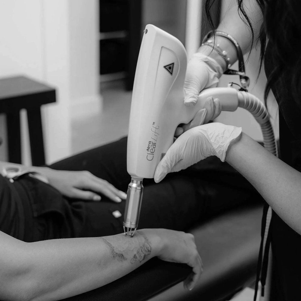 Tattoo Removal