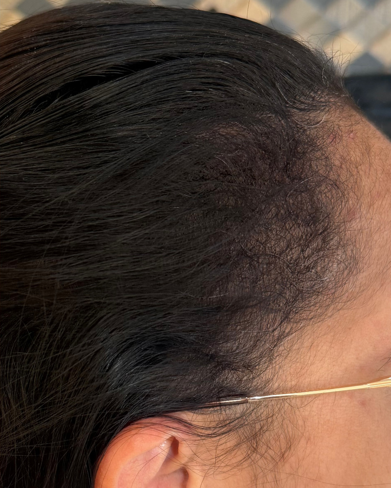 Depois: Recuperação de densidade na linha frontal