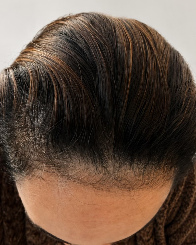 Antes: Fortalecimento e preenchimento da linha anterior