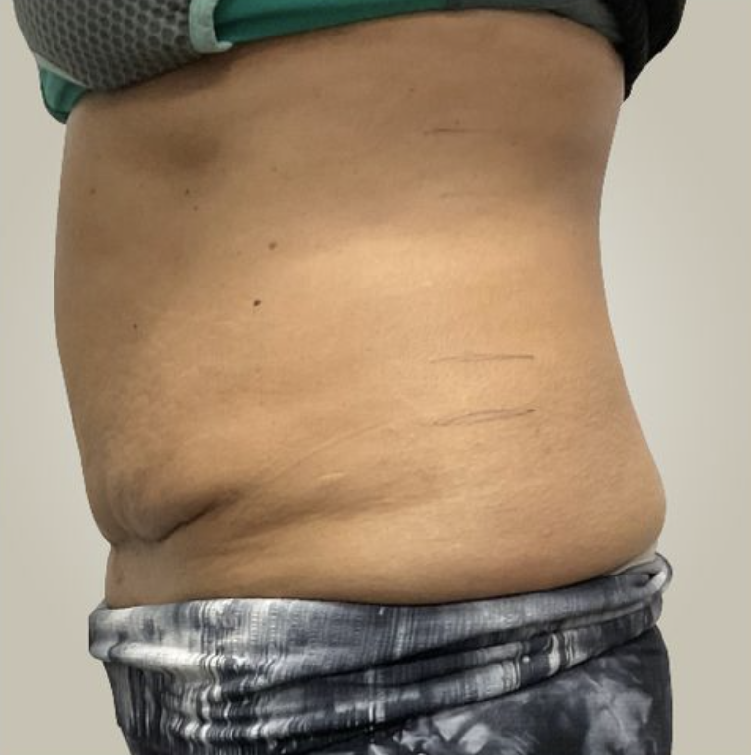 Abdomen, postpartum After