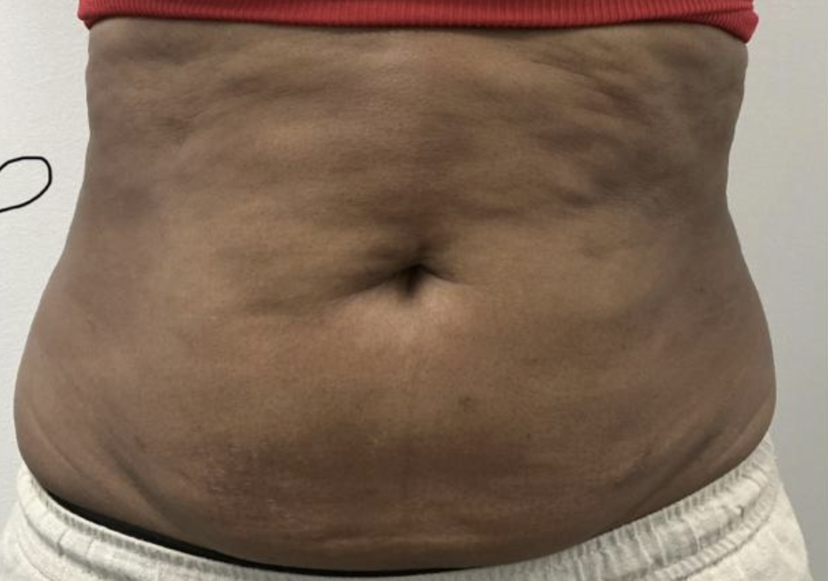 Abdomen Before